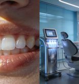 Blanqueamiento dental en casa o clínica: diferencias, ventajas y cómo elegir el tratamiento adecuado